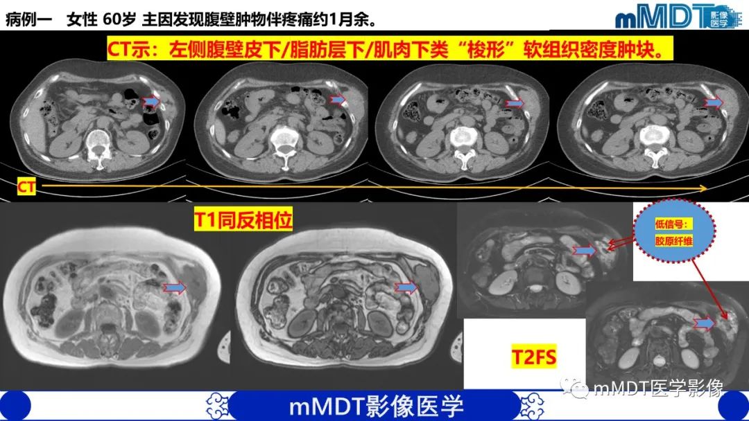 影像PPT - 【PPT】隆起于皮肤的肿瘤探讨-12