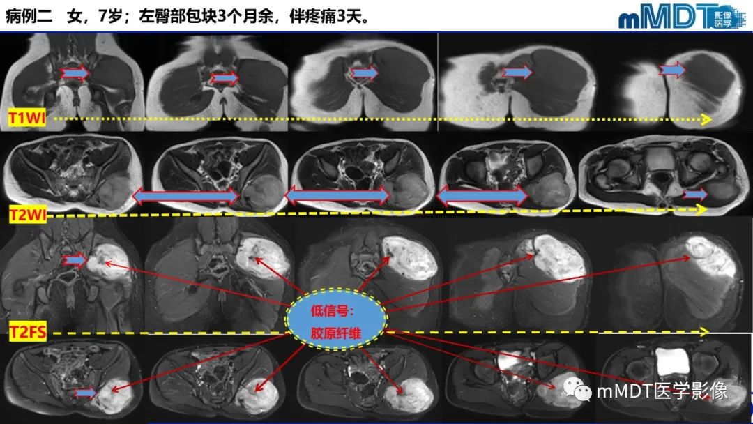 影像PPT - 【PPT】隆起于皮肤的肿瘤探讨-14