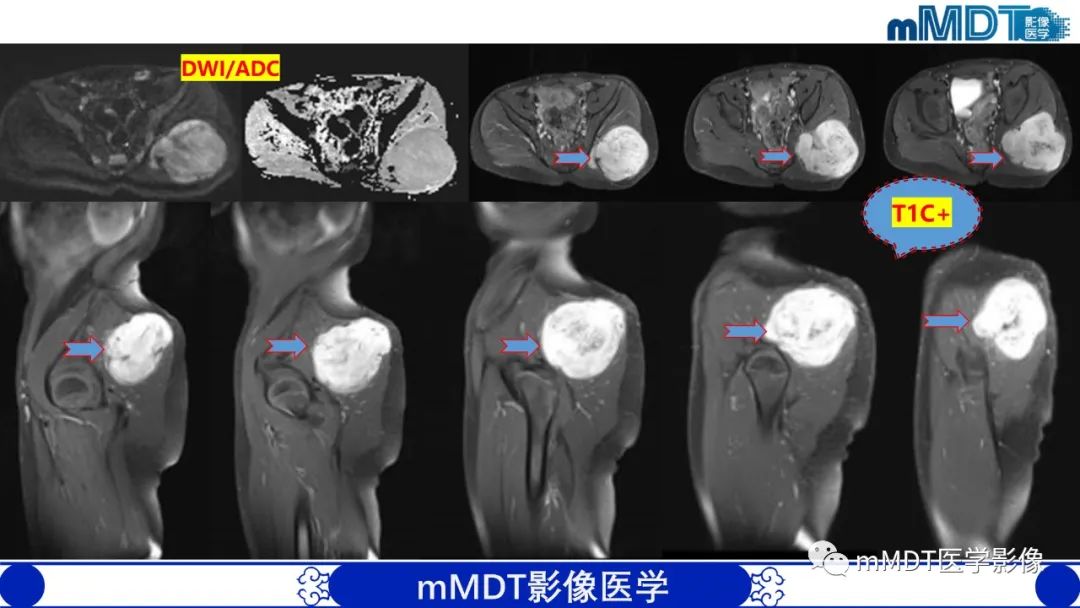 影像PPT - 【PPT】隆起于皮肤的肿瘤探讨-15