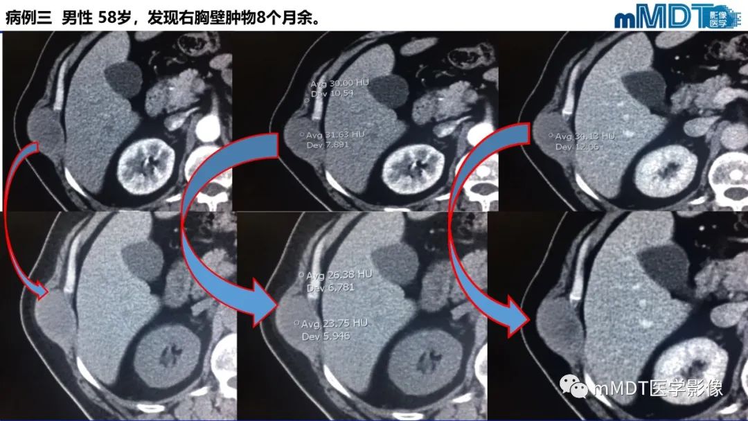 影像PPT - 【PPT】隆起于皮肤的肿瘤探讨-16
