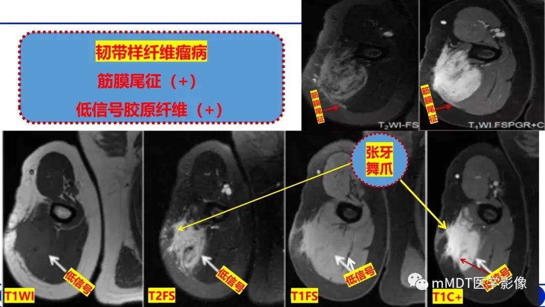 影像PPT - 【PPT】隆起于皮肤的肿瘤探讨-17
