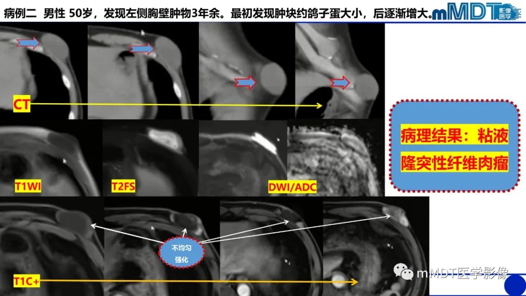 影像PPT - 【PPT】隆起于皮肤的肿瘤探讨-21
