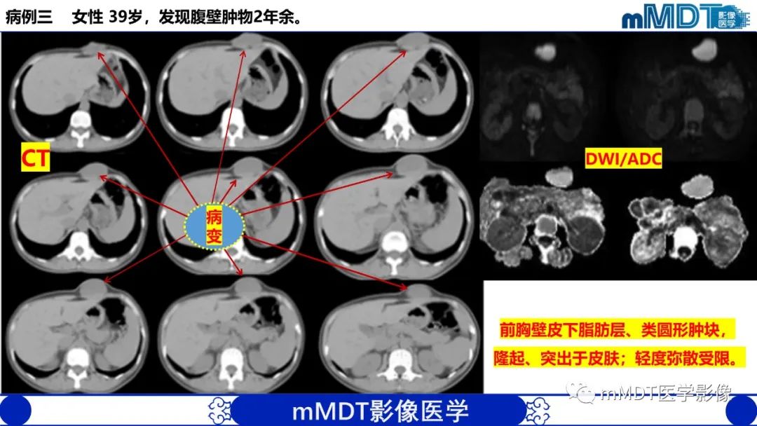 影像PPT - 【PPT】隆起于皮肤的肿瘤探讨-22