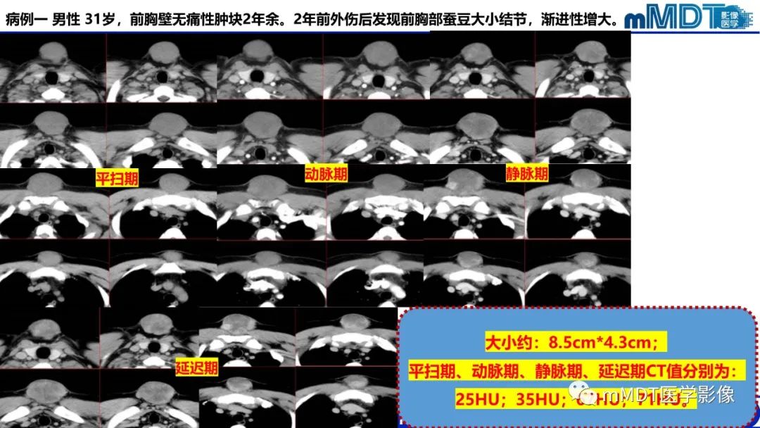 影像PPT - 【PPT】隆起于皮肤的肿瘤探讨-20