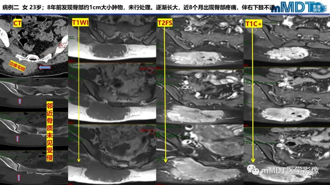 影像PPT - 【PPT】隆起于皮肤的肿瘤探讨-28