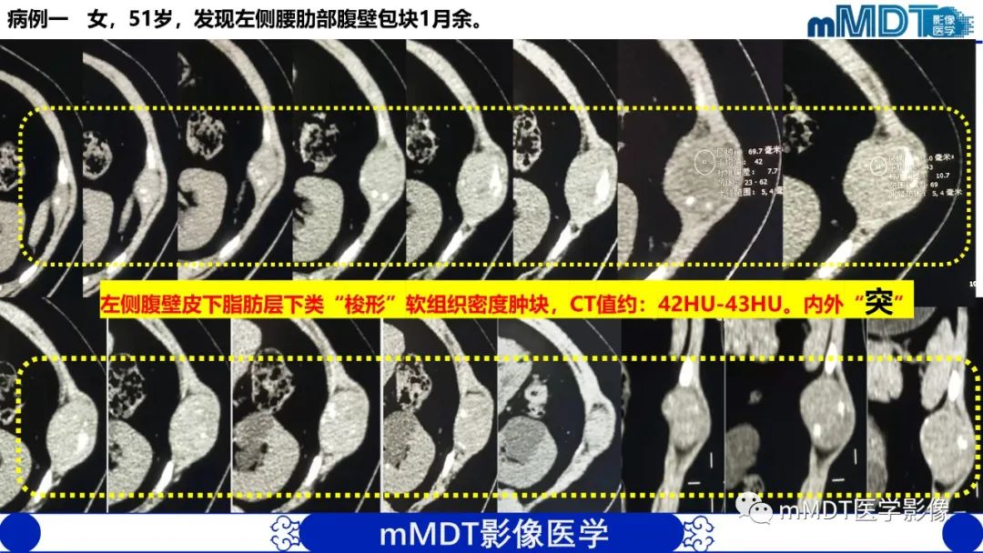 影像PPT - 【PPT】隆起于皮肤的肿瘤探讨-27