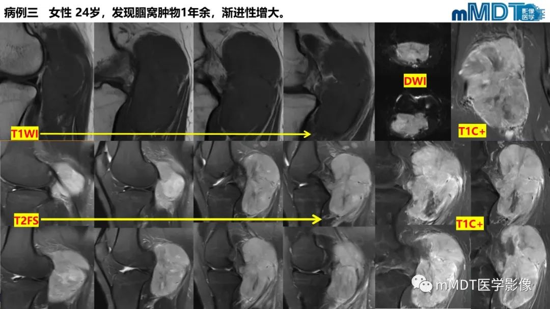 影像PPT - 【PPT】隆起于皮肤的肿瘤探讨-29