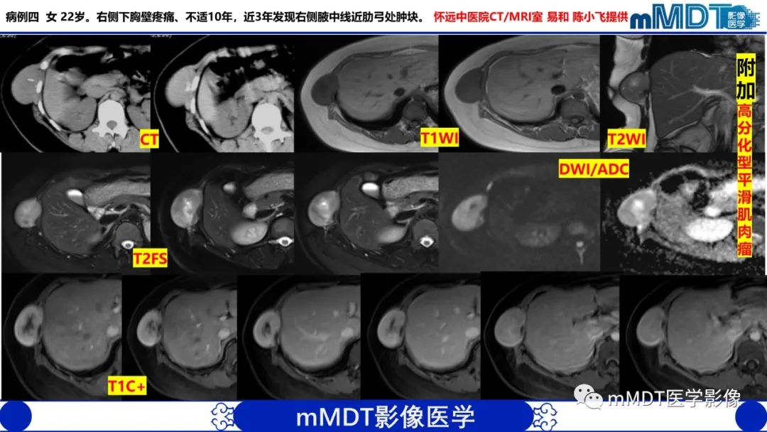 影像PPT - 【PPT】隆起于皮肤的肿瘤探讨-36