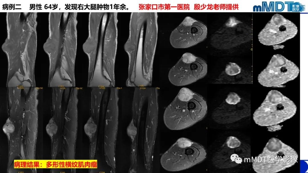 影像PPT - 【PPT】隆起于皮肤的肿瘤探讨-34