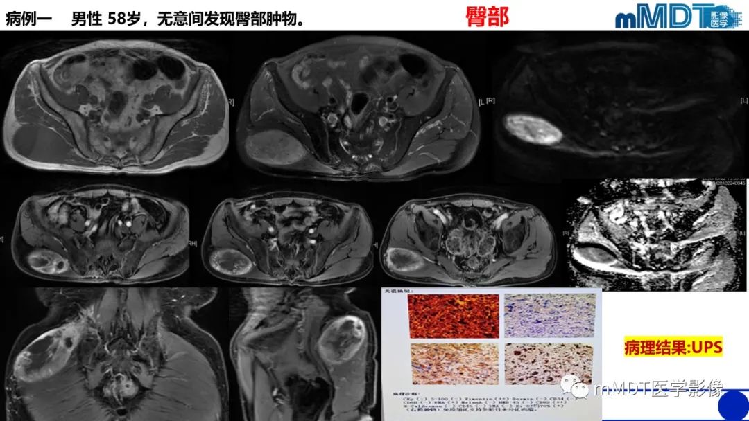 影像PPT - 【PPT】隆起于皮肤的肿瘤探讨-40