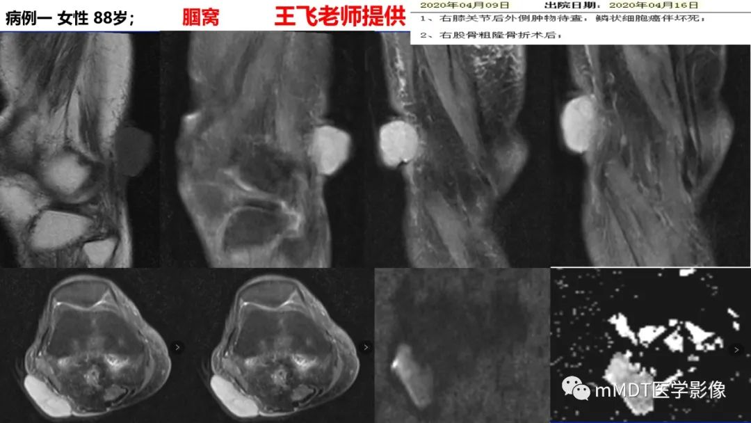 影像PPT - 【PPT】隆起于皮肤的肿瘤探讨-47
