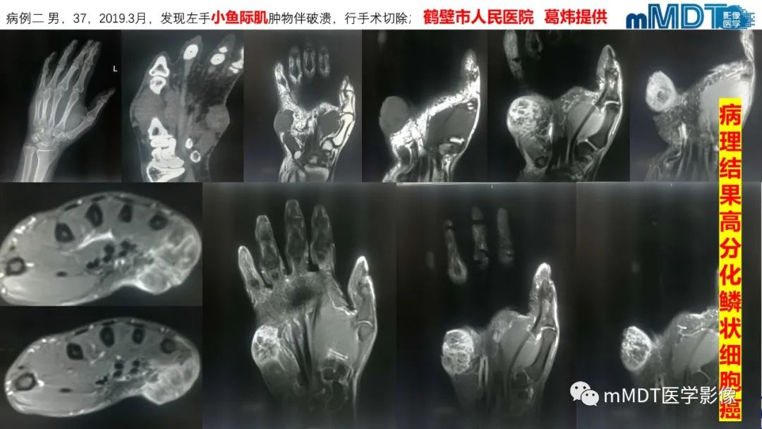 影像PPT - 【PPT】隆起于皮肤的肿瘤探讨-48