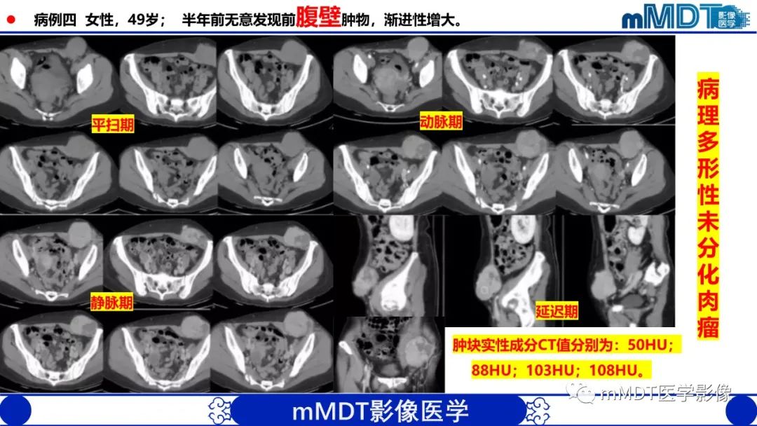 影像PPT - 【PPT】隆起于皮肤的肿瘤探讨-43
