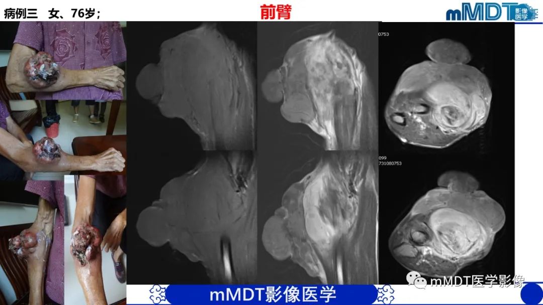 影像PPT - 【PPT】隆起于皮肤的肿瘤探讨-42