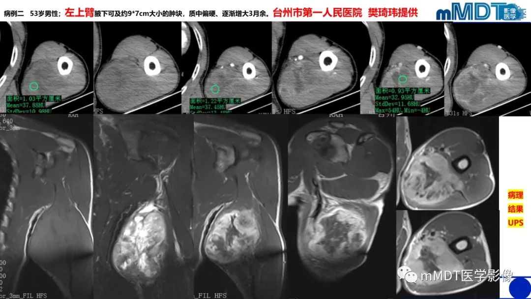 影像PPT - 【PPT】隆起于皮肤的肿瘤探讨-41