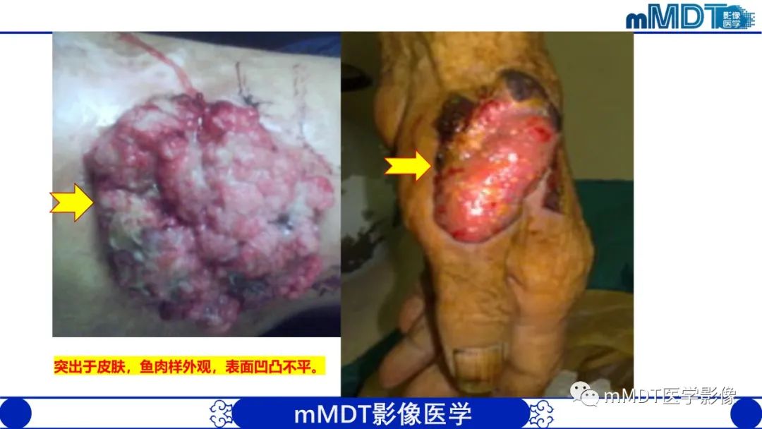 影像PPT - 【PPT】隆起于皮肤的肿瘤探讨-46
