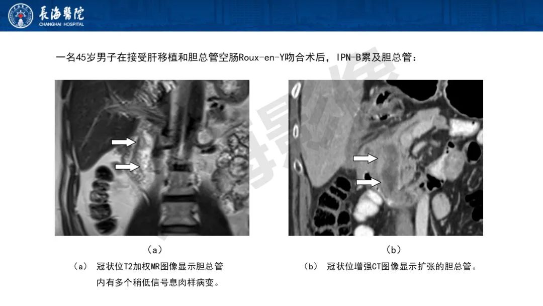 影像PPT - 【PPT】罕见胆道腔内肿瘤的影像学表现-9