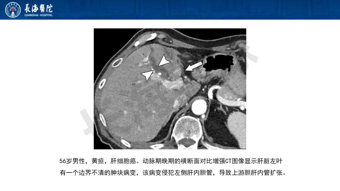 影像PPT - 【PPT】罕见胆道腔内肿瘤的影像学表现-25