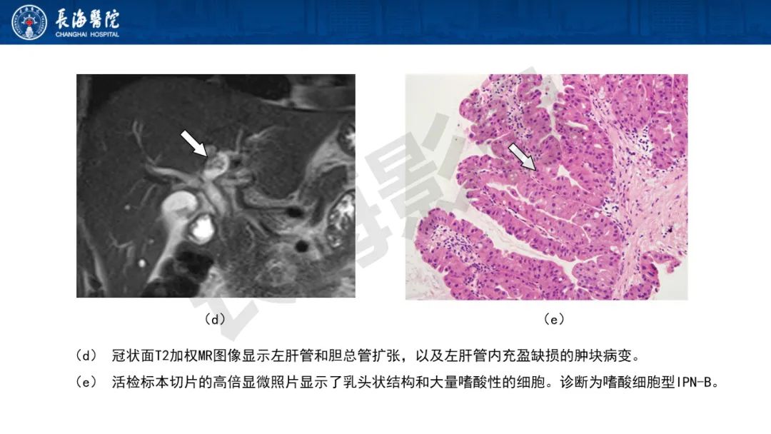 影像PPT - 【PPT】罕见胆道腔内肿瘤的影像学表现-12