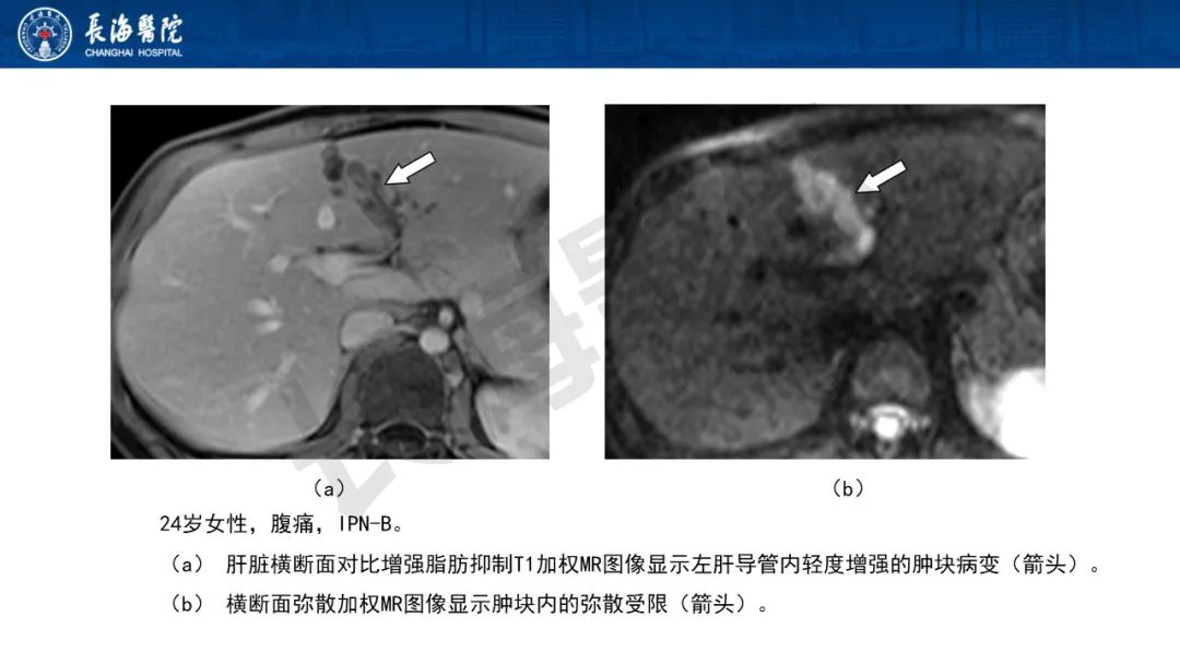 影像PPT - 【PPT】罕见胆道腔内肿瘤的影像学表现-17