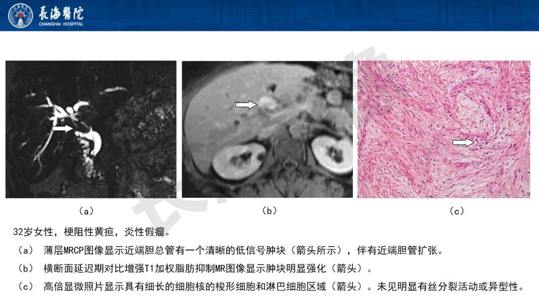 影像PPT - 【PPT】罕见胆道腔内肿瘤的影像学表现-24