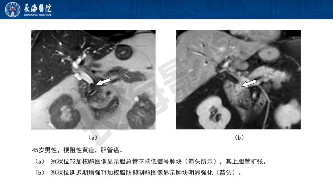 影像PPT - 【PPT】罕见胆道腔内肿瘤的影像学表现-26
