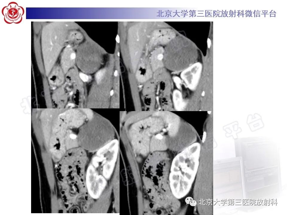 影像PPT - 【PPT】肾上腺节细胞神经瘤-7