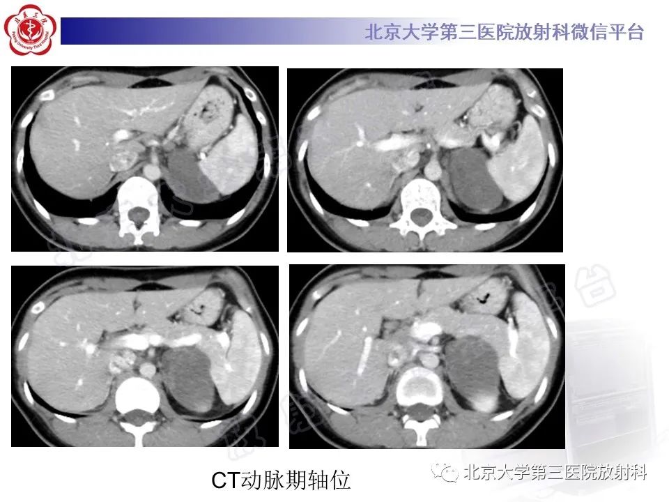 影像PPT - 【PPT】肾上腺节细胞神经瘤-4