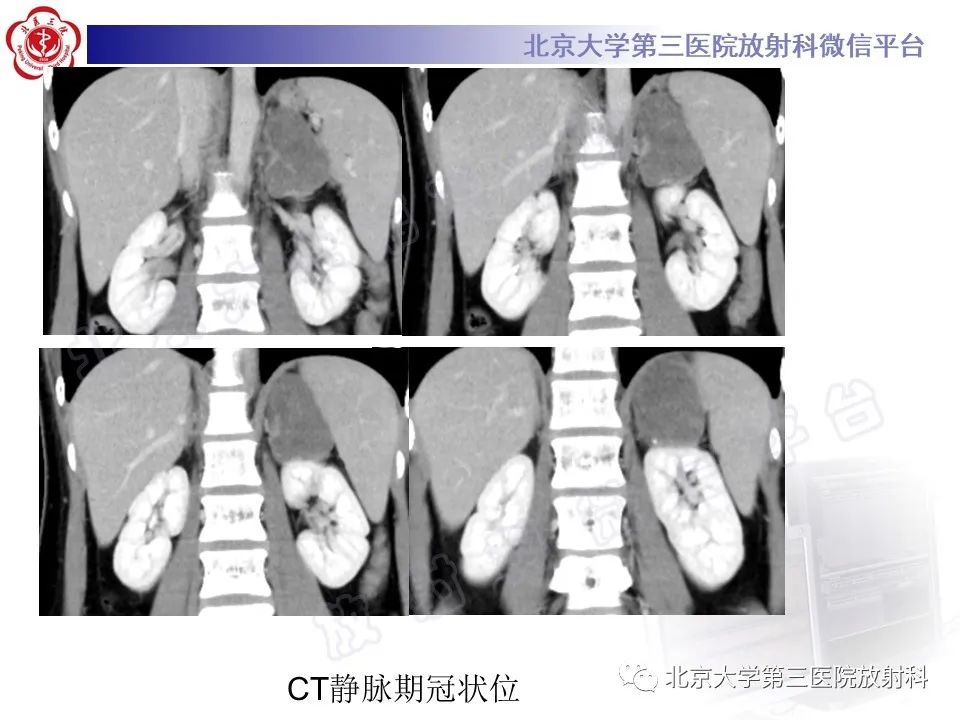 影像PPT - 【PPT】肾上腺节细胞神经瘤-8