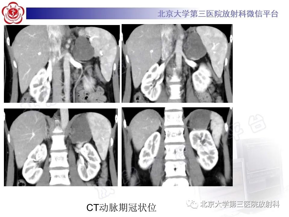 影像PPT - 【PPT】肾上腺节细胞神经瘤-6