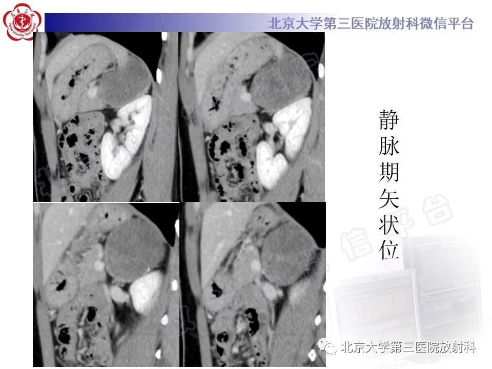 影像PPT - 【PPT】肾上腺节细胞神经瘤-9