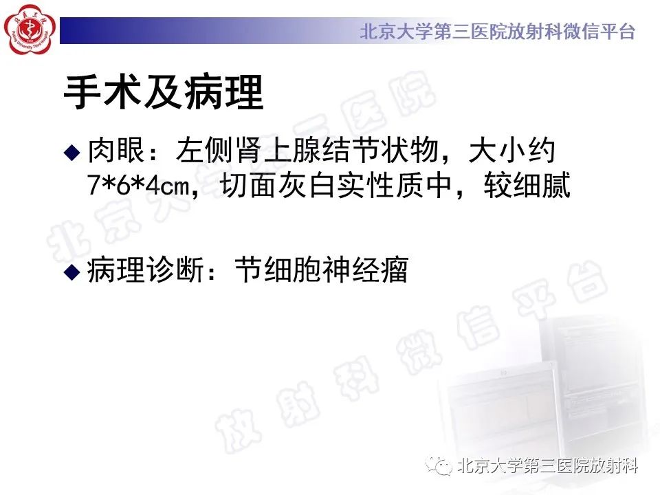 影像PPT - 【PPT】肾上腺节细胞神经瘤-11