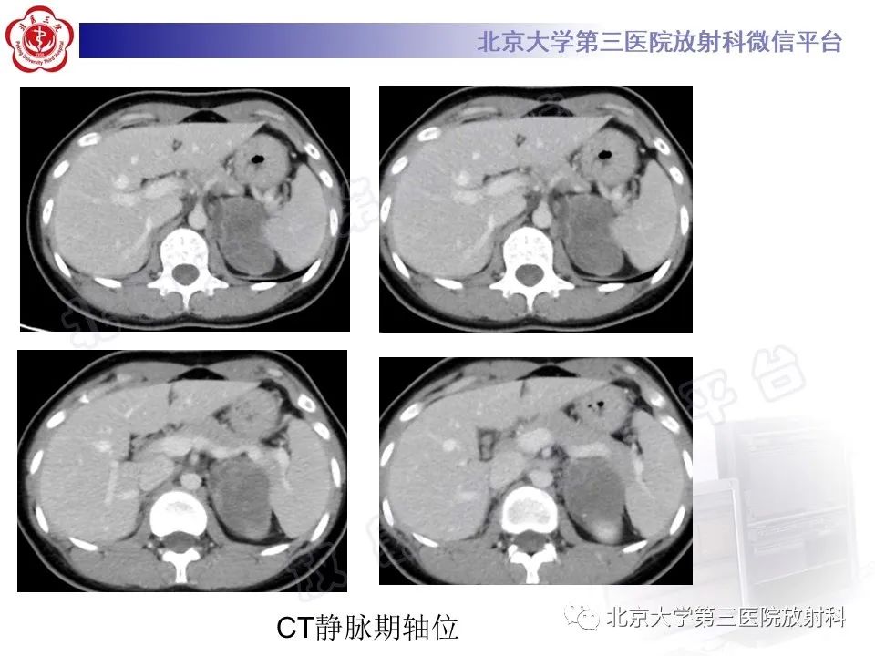 影像PPT - 【PPT】肾上腺节细胞神经瘤-5