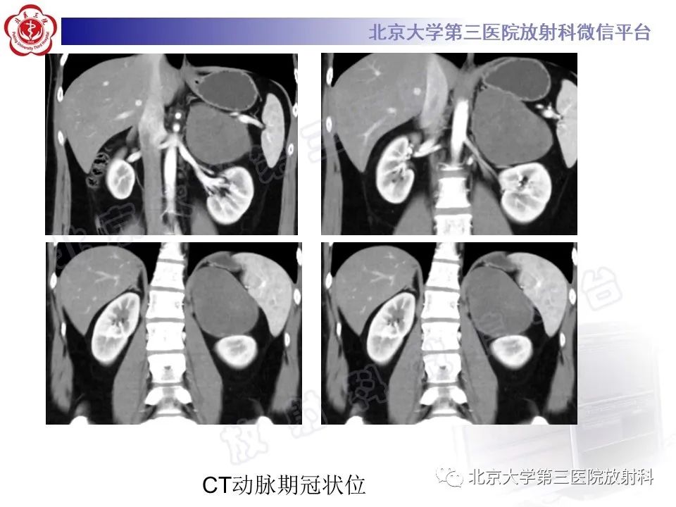 影像PPT - 【PPT】肾上腺节细胞神经瘤-16