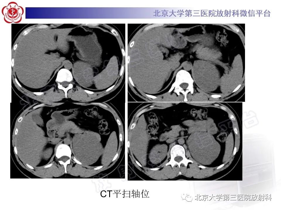 影像PPT - 【PPT】肾上腺节细胞神经瘤-13
