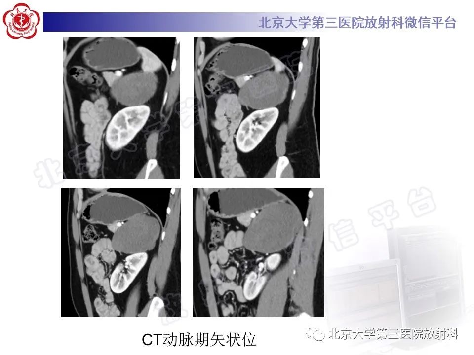 影像PPT - 【PPT】肾上腺节细胞神经瘤-17