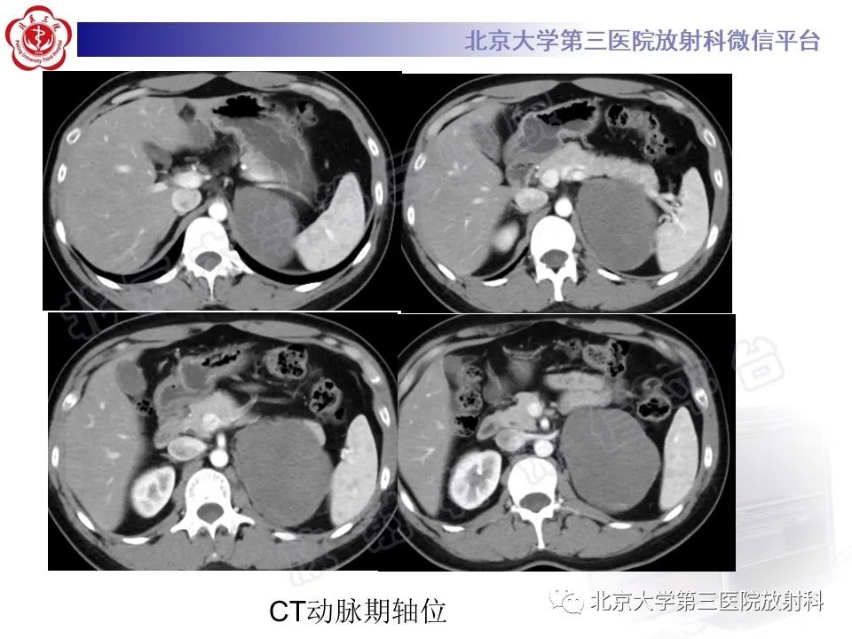 影像PPT - 【PPT】肾上腺节细胞神经瘤-14