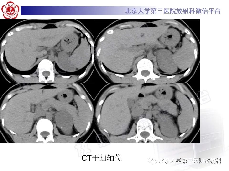 影像PPT - 【PPT】肾上腺节细胞神经瘤-3