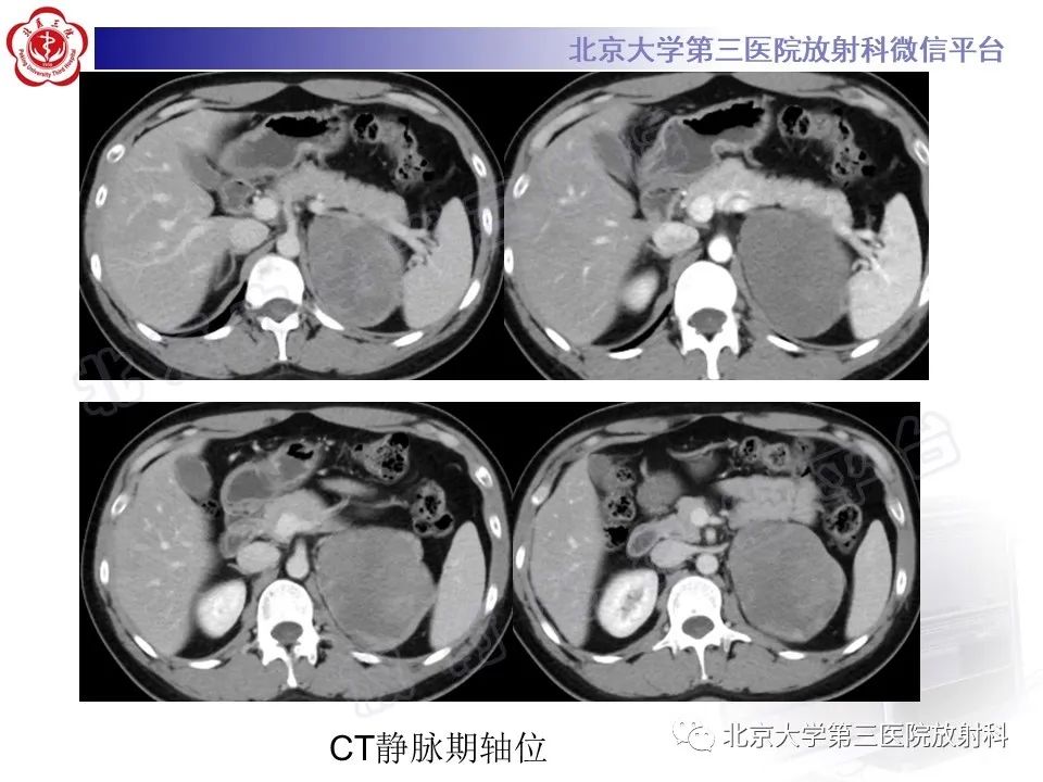 影像PPT - 【PPT】肾上腺节细胞神经瘤-15