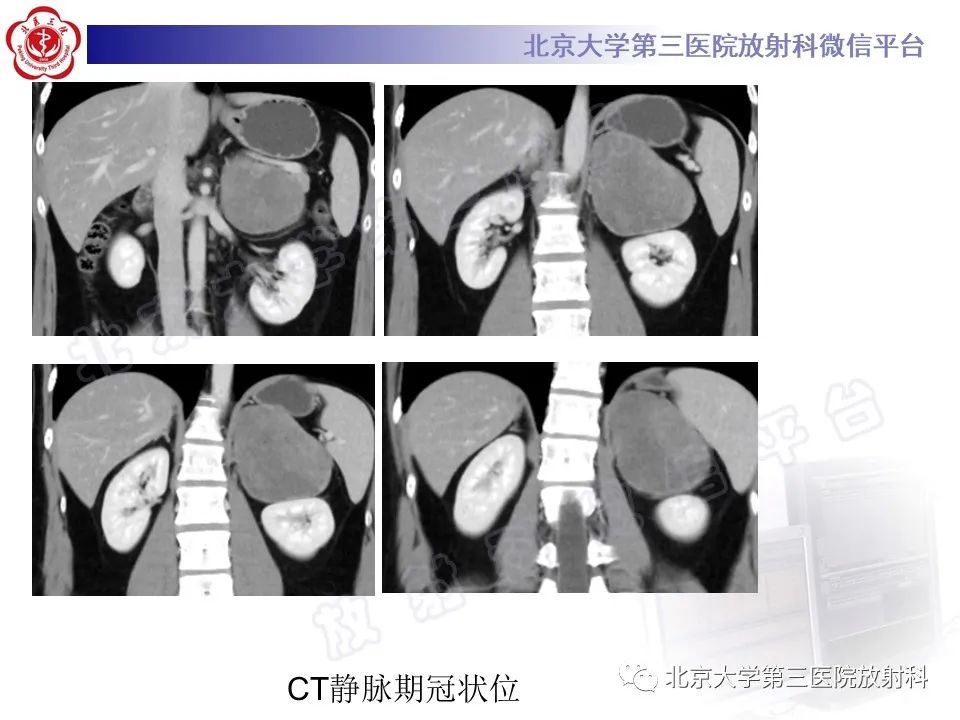 影像PPT - 【PPT】肾上腺节细胞神经瘤-18