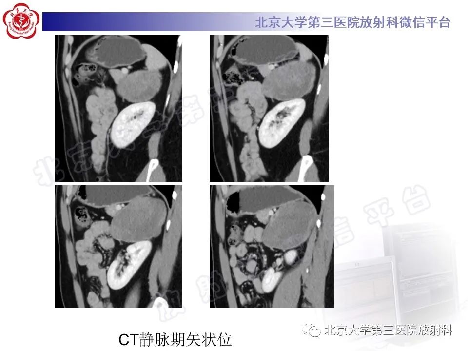 影像PPT - 【PPT】肾上腺节细胞神经瘤-19