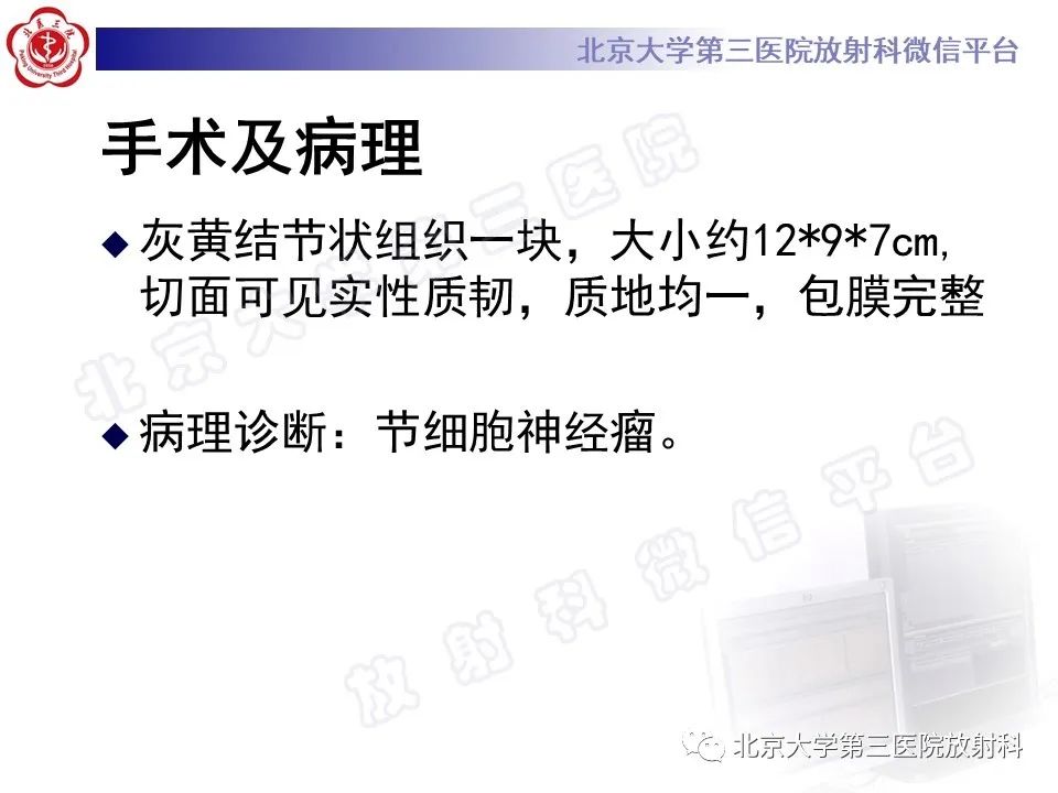 影像PPT - 【PPT】肾上腺节细胞神经瘤-21