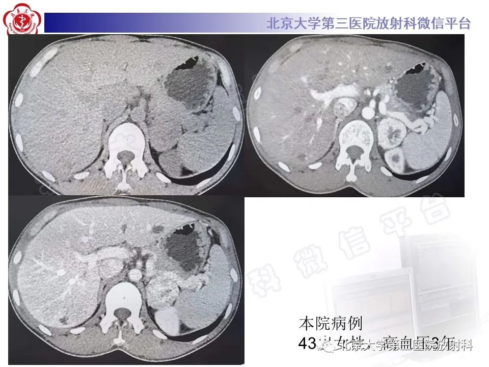 影像PPT - 【PPT】肾上腺节细胞神经瘤-33