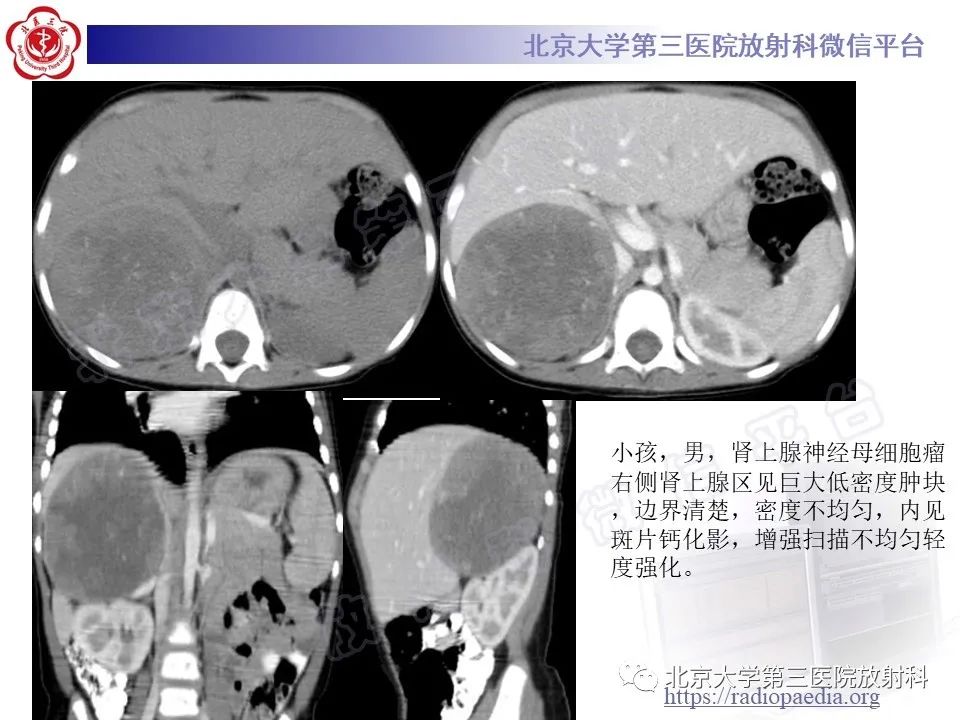 影像PPT - 【PPT】肾上腺节细胞神经瘤-35