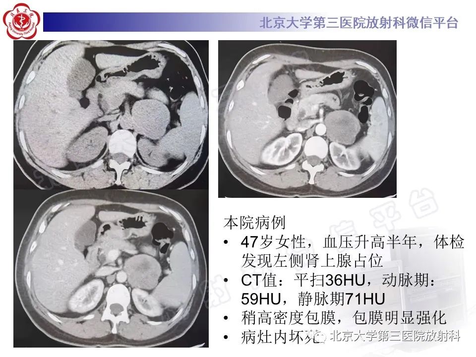影像PPT - 【PPT】肾上腺节细胞神经瘤-37
