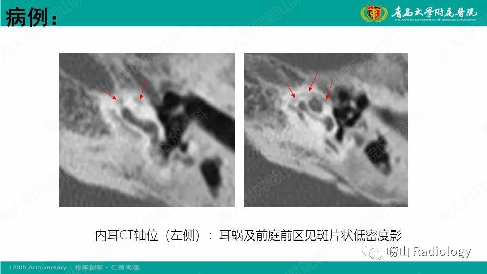 影像PPT - 【病例】耳硬化症1例CT影像-5