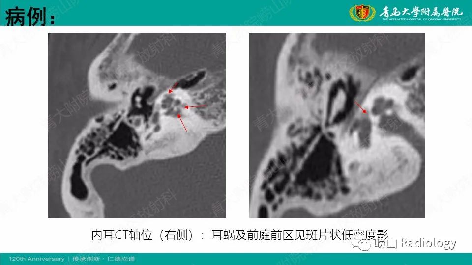 影像PPT - 【病例】耳硬化症1例CT影像-4