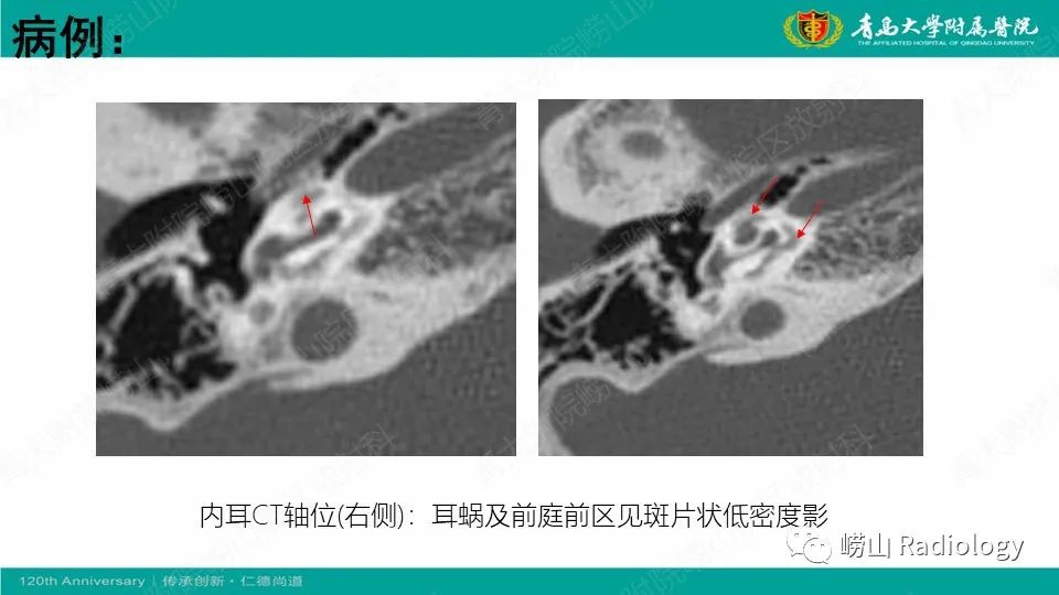 影像PPT - 【病例】耳硬化症1例CT影像-3