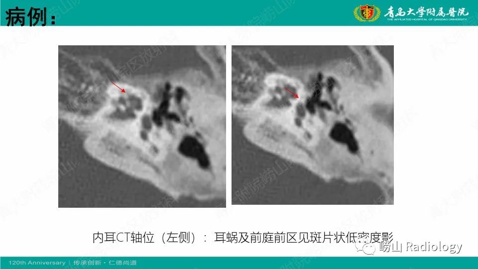 影像PPT - 【病例】耳硬化症1例CT影像-6