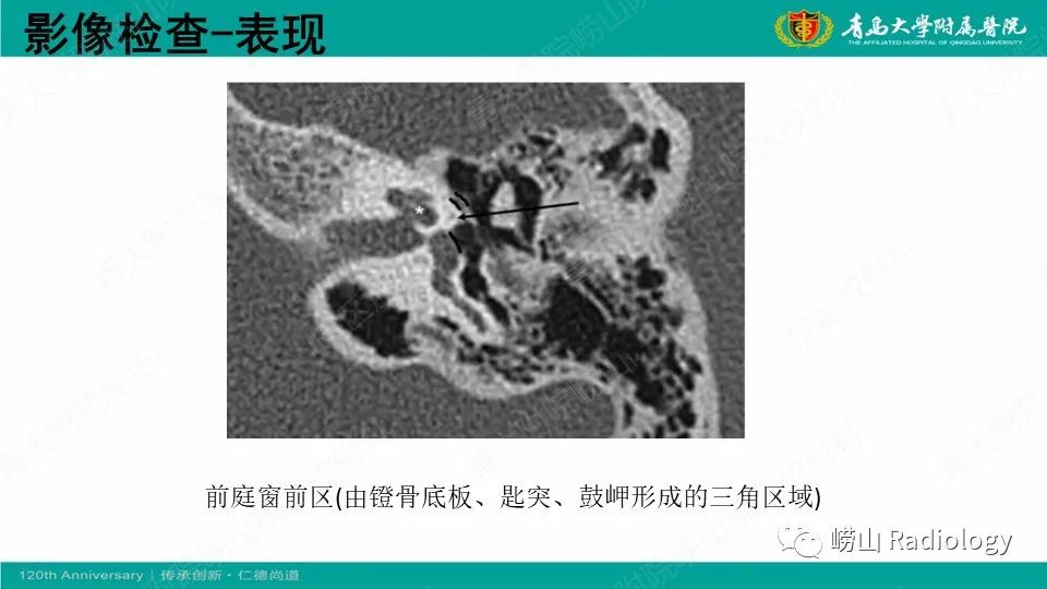 影像PPT - 【病例】耳硬化症1例CT影像-14